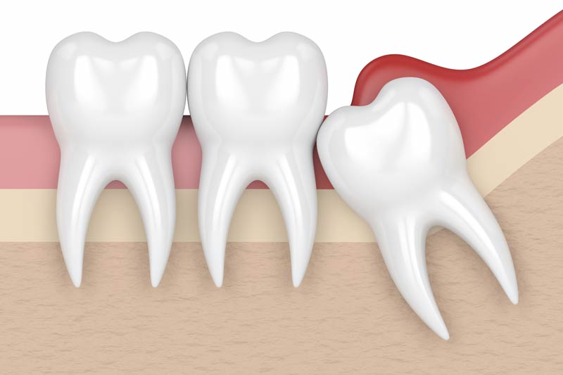 Wisdom Tooth Removal in Austin